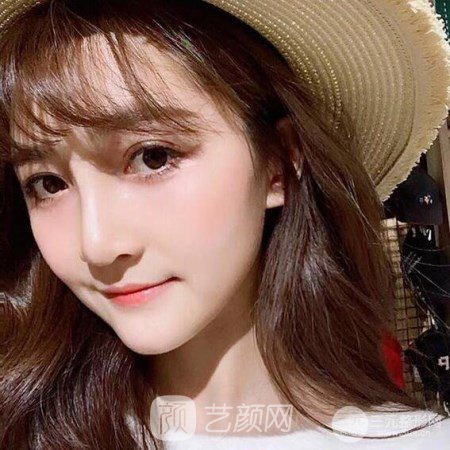 武漢華亞李愛林自體脂肪面部填充三個(gè)月案例分享~